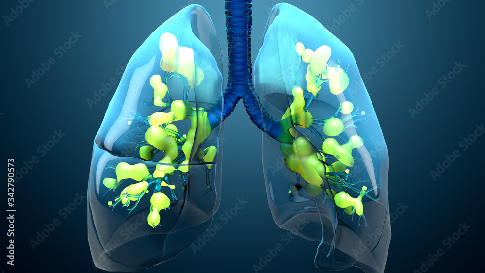Damage lungs, severe respiratory illness, pneumonia, ARDS, acute respiratory distress syndrome caused by the coronavirus - obrazy, fototapety, plakaty 