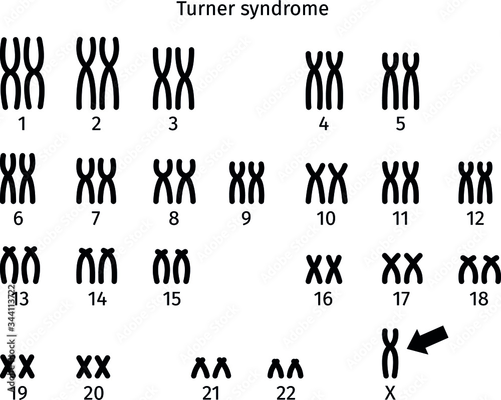 Scheme of Turner syndrome karyotype of human somatic cell 45X0 - obrazy, fototapety, plakaty 