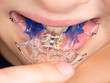 View of child jaw with braces installed to tooth.
