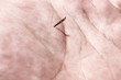 Splinter palm skin. Hand background for medical remove spike.