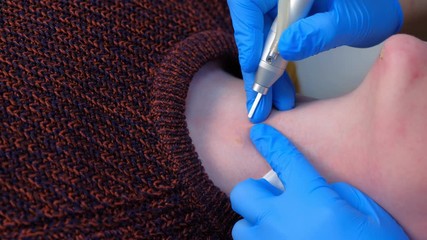 Wall Mural - Process of removing mole using laser on woman's neck by surgeon, burning skin, closeup view. Cosmetic treatment in beauty clinic. One day surgery concept. Removing birthmark surgical procedure.