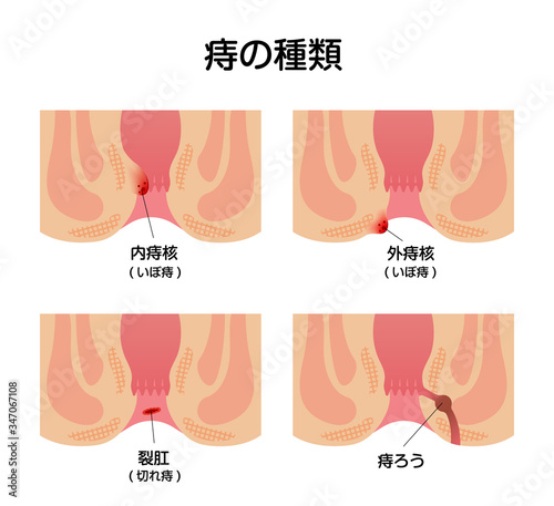 痔のタイプ 種類 肛門断面図イラスト Stock Vector Adobe Stock