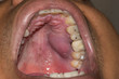palatal dental abscess