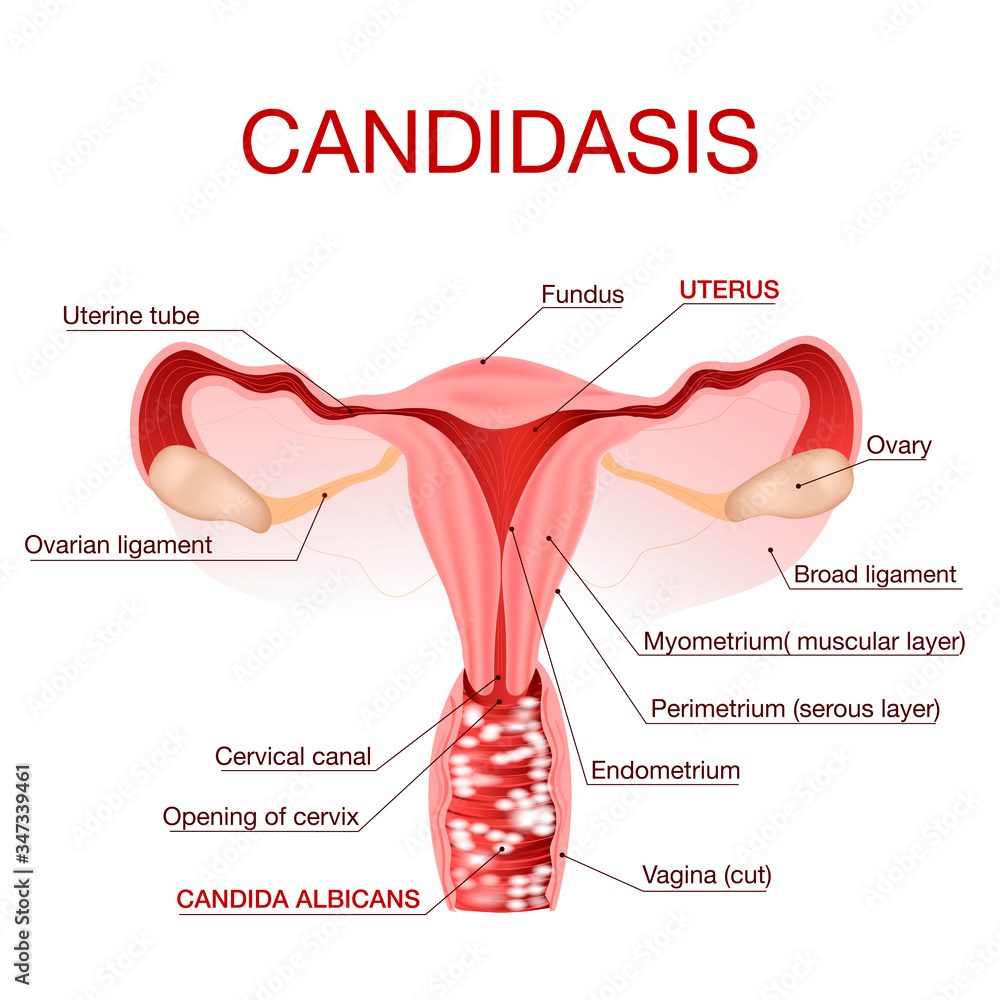 Vaginal Yeast Infection Candidiasis Gynecological Medical Disease  Infographic Body Wall Mural | Bo-Koroleva