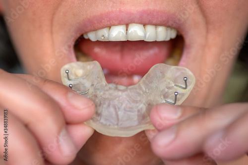 Fotografía Woman suffering from bruxism holding up a guard