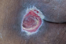 Ulcers Caused By Compression Of Patients