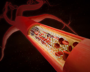 3D illustration of a bypass stent - chronic coronary heart disease