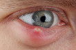 Close up abscess in the eye. hordeolum. stybarley on the eye. inflammation. stye