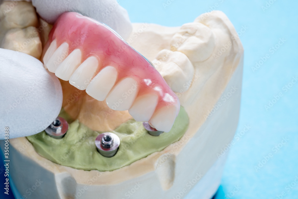 Dental implant work is completed and ready to use/ dental implant ...