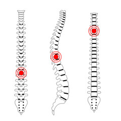 Canvas Print - Human spine pain vector illustration