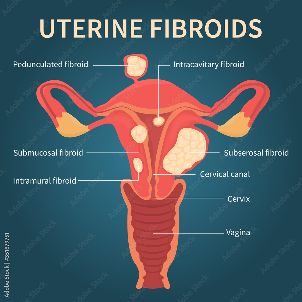 Emerging treatment options for uterine fibroids, image size:1000x1000