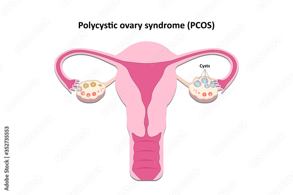 Illustration of Polycystic ovary syndrome Stock Vector | Adobe Stock
