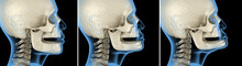 Mandibular Jaw, Bone Recession After Losing Teeth. Medically Accurate Dental 3D Illustration
