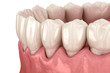 Gum recession process. Medically accurate 3D illustration