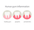 Human gum inflammation.Information about dental heath.