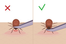 A Tick Bites A Person. How To Remove A Tick From The Skin. A Parasite Carrying A Disease. Vector Illustration