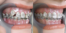 3D Illustration Of Before And After Dental Appliance Treatment. Orthodontic Technology Before And After.
