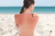 Woman with sunburn on beach. Skin protection from sun in summer