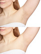 Girl underarm. White woman armpit. Before and after epilation collage. Wax depilation result concept. Laser hair removal. sugaring spa procedure. Health care home routine. IPL treatment. Isolated