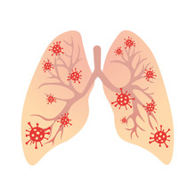 Viruses In Lungs Vector Illustration. Concept Of Viral Respiratory Infection, Coronavirus, Bronchitis.