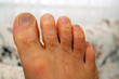 fungal infection on a man's toes, neglected male toes,