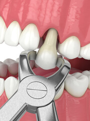 Wall Mural - 3d render of lower jaw with tooth extraction