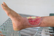 Close up of a senior leg with infected wound from accident. Medical concept.