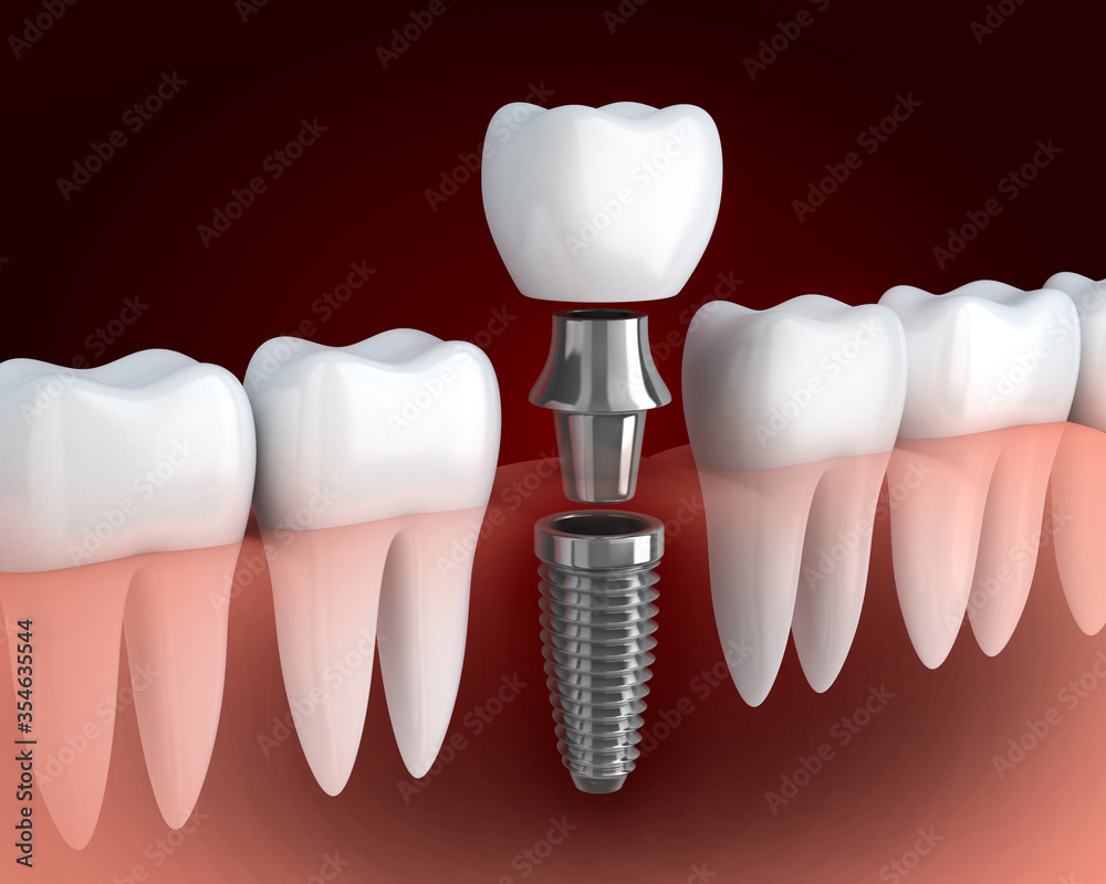 Row tooth white and dental implant - obrazy, fototapety, plakaty 