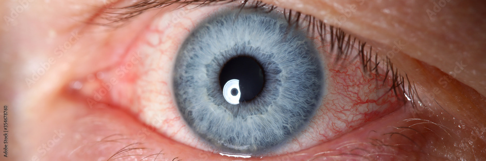 Irritated left blue male eye full with red capillar net - obrazy, fototapety, plakaty 