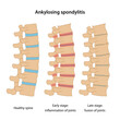 Stages of Ankylosing spondylitis: healthy disc, inflammation of joints and fusion of joints. Medical vector illustration in flat style is isolated on white background