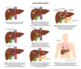 Wall Mural - Four stages of liver cancer with description corresponding steps of tumor spread. Medical vector illustration in flat style isolated over white background