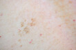 Acne marks, Red spot and uneven skin tone.