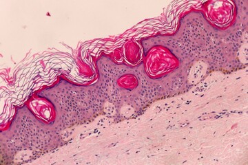 Wall Mural - Skin section with a benign  hypertrophic seborrheic keratosis. Microscopic view.