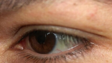 Close up of two annoyed red blood eyes of male affected by conjunctivitis or after flu, cold, allergy. Copy space for advertisement. Tired eyes after working at the computer. Close-up videos and macro