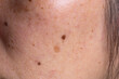 © Saman - Close-up of spots and blackheads on the face
