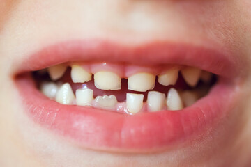 Close up child caries