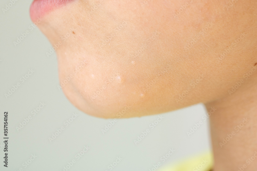 Close-up of Molluscum Contagiosum also called water wart. Viral formations in the chin on the skin of the child.