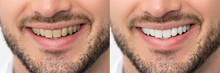 Teeth Before And After Whitening