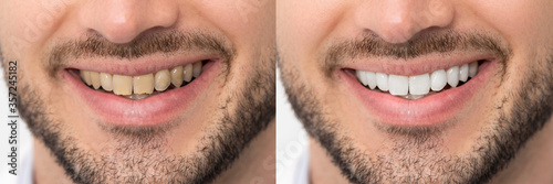 Cuadros en Lienzo Teeth before and after whitening