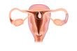 Endometrial polyp or uterine polyp.