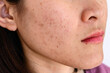 © boyloso - Woman face has variety problems on her skin (such as Acne, Pimple, Pores and Melasma etc).