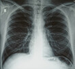 Plain chest x-ray, normal healthy lungs