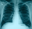 © Kondor83 - Plain chest x-ray, normal healthy lungs