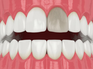 Wall Mural - 3d render of jaw and tooth with dead pulp