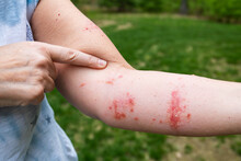 Severe Poison Ivy Poison Oak Rash And Boils And Blisters On Woman's Arm. Itchy Scratchy Pain