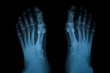 Film X-ray of Rheumatoid arthritis leg shows joint space narrowing of the legs. Rheumatoid arthritis patient's legs in x-ray. Medical and healthcare shot. Radiology concept.