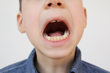 Poster - boy, kid opened his mouth, oral cavity, close-up teeth, performs articulation exercises for the tongue, vocals, dental concept, speech therapy