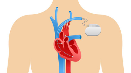 Pacemaker anatomical scheme - human body silhouette, heart, veins, arteries and heart implant - vector medical presentation