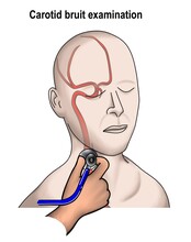 The Physcial Examination Of Right Carotid Bruit Which Is The Neurological Examination For Carotid Stenosis.
