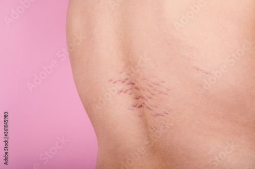 Close up view of the back with striae distensae (striae rubrae) on the skin on a pink background. The concept of impaired skin elasticity during puberty